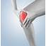Arthritis & Knee Replacement Pain  Kozmary Center