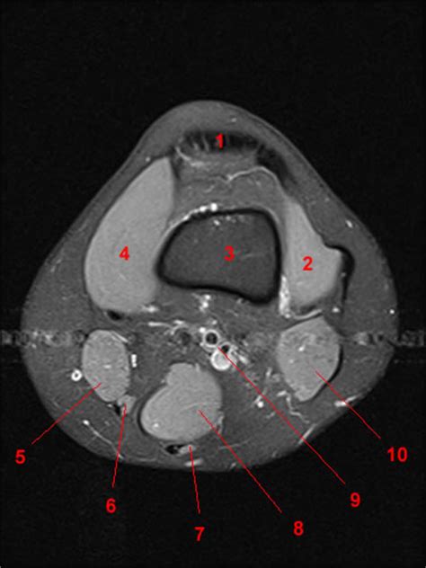Magnetic resonance imaging is particularly well suited for the medical evaluation of the musculoskeletal (msk) system including the knee it includes a very simplified approach to the mri imaging sequences and the thought process behind why we use those sequences. Atlas of Knee MRI Anatomy - W-Radiology
