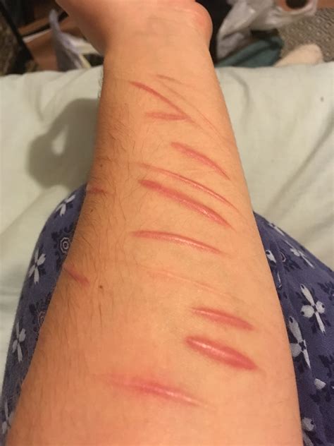 Has Anyone Had Scars Like These Which Have Healedbecome Less