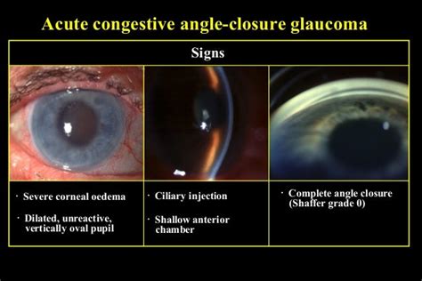 29 Primary Angle Closure Glaucoma