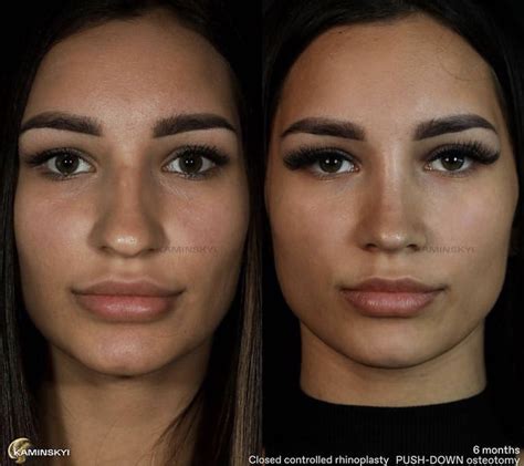 Nose Job For Wide Nose Before And After Winfred Alonzo