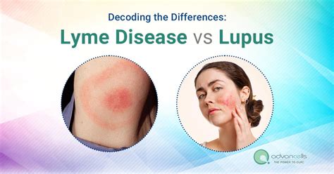 Decoding The Differences Lyme Disease Vs Lupus Atoallinks