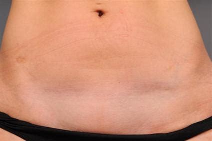 Here's more information on what to expect, plus how to help your incision heal properly and minimize scarring. Photo Gallery - C-Section Scar Removal New York City