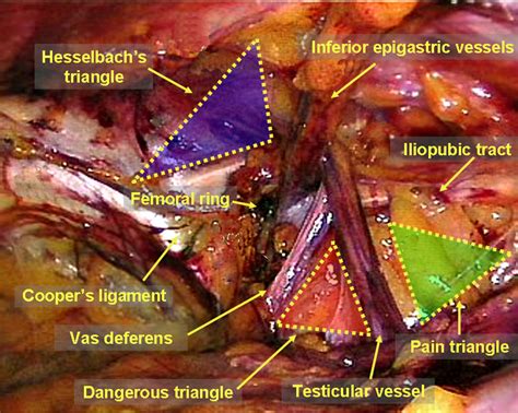 Anatomy Essentials For Laparoscopic Inguinal Hernia Repair Yang