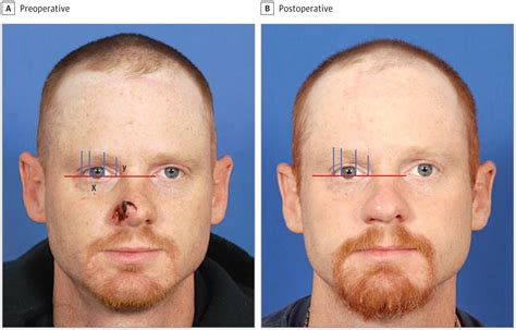 Eyebrow Position After Paramedian Forehead Flap Nasal Reconstruction