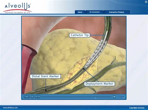 Biliary Stent Animation Interactive Medical Media Youtube