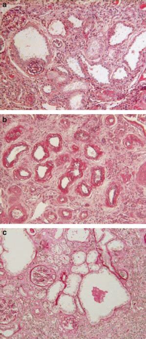 Mutations Of Nphp2 And Nphp3 In Infantile Nephronophthisis Kidney