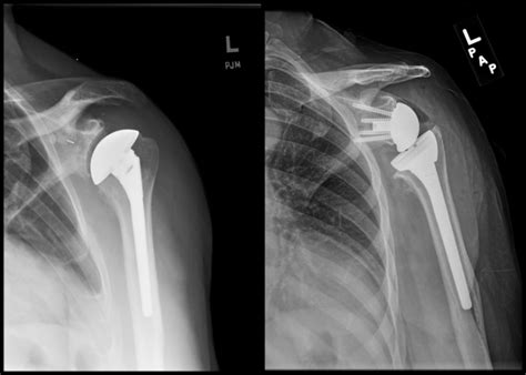 Reverse Shoulder Replacement The Shoulder And Elbow Center