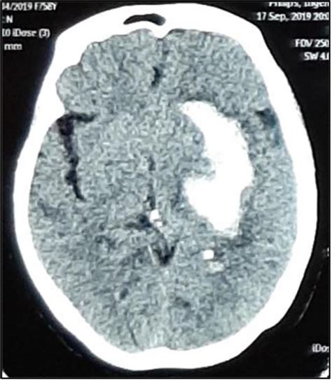Axial View Of Brain Ct Scan Showing A Hyperdense Lesion In The Left
