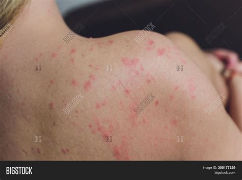 Close Allergy Rash Image And Photo Free Trial Bigstock