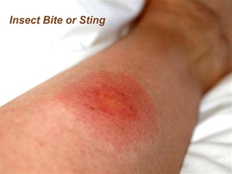 Insect Bites And Stings Health And Medical Information