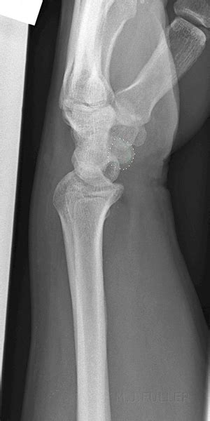 What Constitutes A True Lateral Wrist Position Wikiradiography