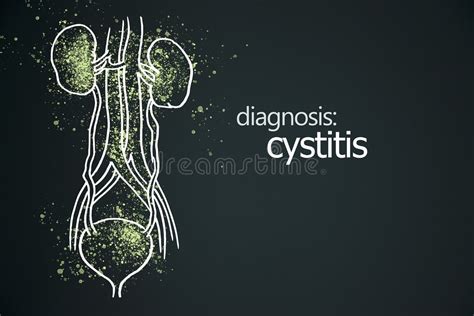 Cystitis Kidneys Poster Stock Illustrations 33 Cystitis Kidneys