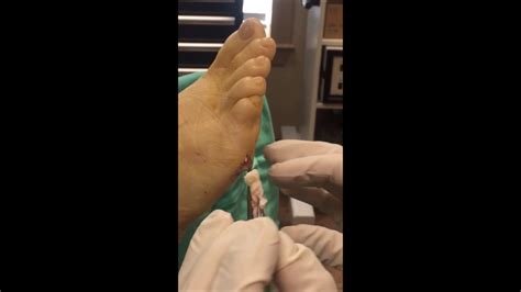 Gout Tophi Removal Youtube