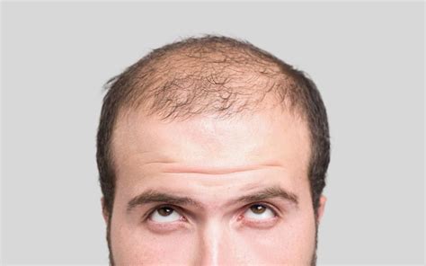 Hair Loss In Men Dr Walia S Skin And Laser Clinic