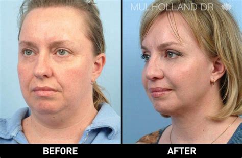 Blapharoplasty Eye Lid Cosmetic Surgery Before And After Photo Of