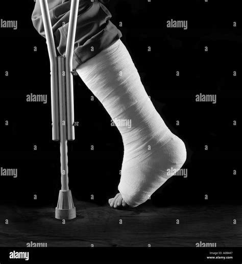 Broken Leg Cast High Resolution Stock Photography And Images Alamy