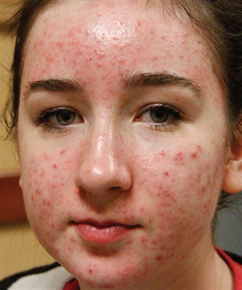 Albums 90 Pictures Pictures Of Acne On The Face Excellent