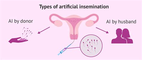 The Intrauterine Insemination Iui Process Step By Step
