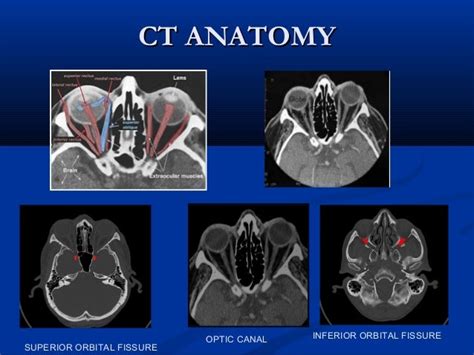 Orbital Ct Scan Anatomy Ct Scan Machine