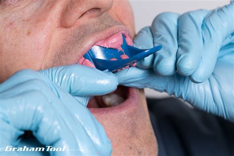 Removable Tongue Thrust Dental Appliance Habit Breaker Tongue Crib At Home — Graham Tool