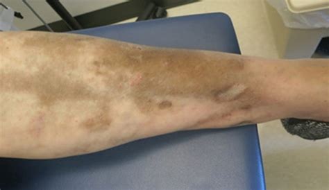 Pigmented Lesions Of The Leg Dermatology Games