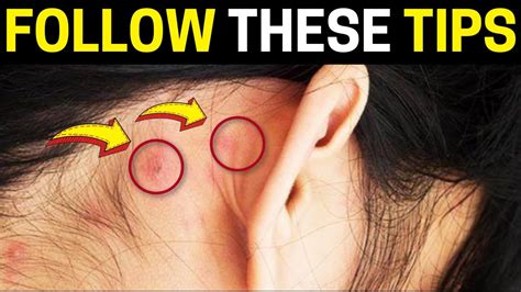 Pimples Behind The Ear The Best Prevention Tips Youtube