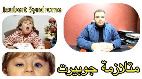 متلازمة جوبيرت Joubert Syndrome Youtube