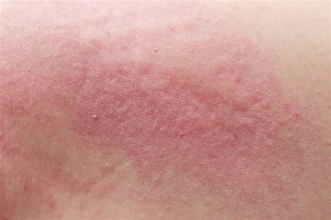 Scabies In Children Symptoms Causes And Treatment You Are Mom