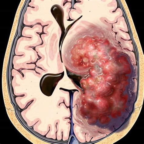 Sintomas De Tumor Na Cabeça Infantil