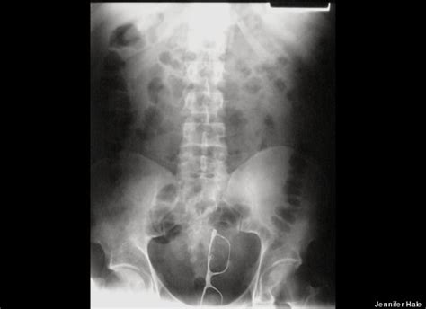 New Book Looks At X Rays Of Objects Stuck In Patients Orifices Photos