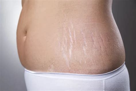 Female Belly With Pregnancy Stretch Marks Closeup Stock Image Everypixel