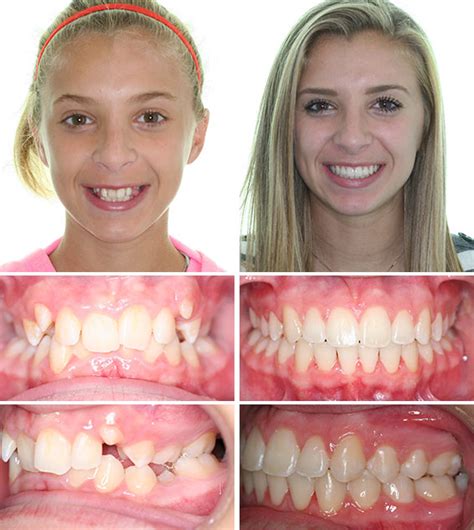 We did not find results for: Before & After Photos - Corbridge Orthodontics | Frisco TX