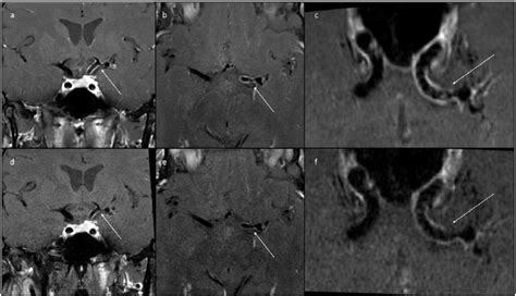 Contrast Enhanced High Resolution Mri Hrmr Over Time In Patient 2 At