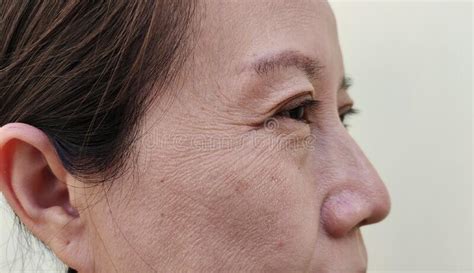 The Wrinkle And Freckles Blemish And Flabby Skin Dark Spots And