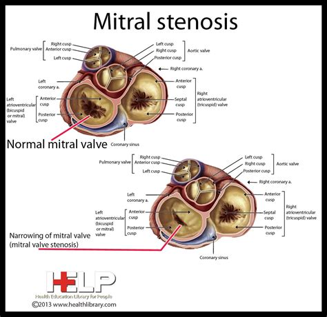 Mitral Stenosis Medical School Essentials Diagnostic Medical