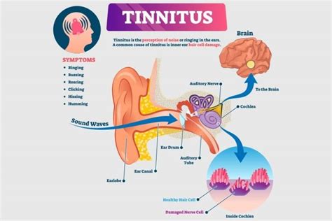 Common Causes Of Tinnitus Curing Tinnitus