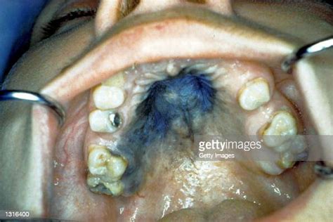 A Detail Of A Persons Mouth With A Malignant Melanoma Of The Palate