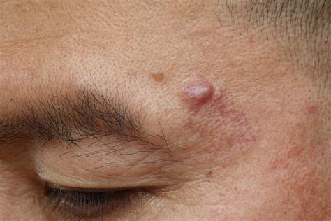 Cyst Removal Causes Diagnosis Treatment Options Pictures
