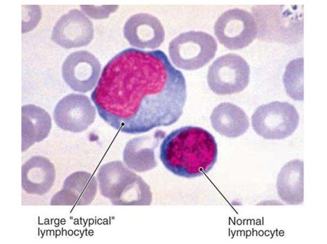 Infectious Mononucleosis Pathology