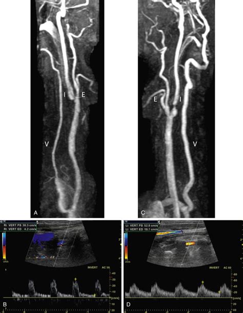 Ultrasound Assessment Of The Vertebral Arteries Radiology Key