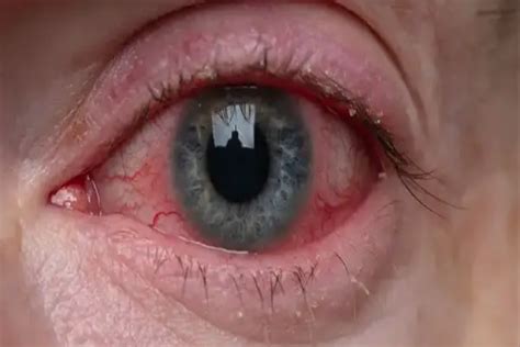 Υγρασία αλλεργίες Η σύνδεση των αλλεργιών στα μάτια με την υγρασία του