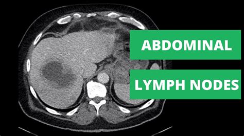 Abdominal Lymph Nodes Anatomy Schematic Diagram Of Lymph Node Station