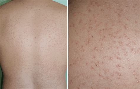 Fungal Acne What It Looks Like And The Treatment For It