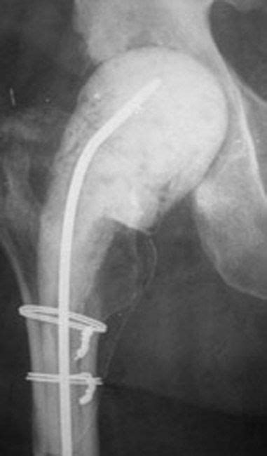 Infected Hip Replacement Adam Watson Orthopaedic Surgeon
