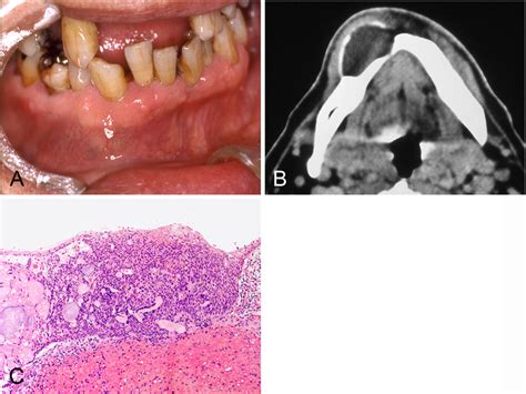 Clinicopathological Findings Of The Initial Calcifying Cystic