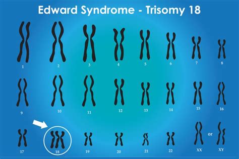 Mengenal Gejala Trisomy 18 Atau Edward Syndrome Riset