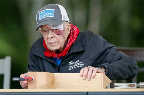 Former President Jimmy Carter With A Black Eye And 14 Stitches But 100