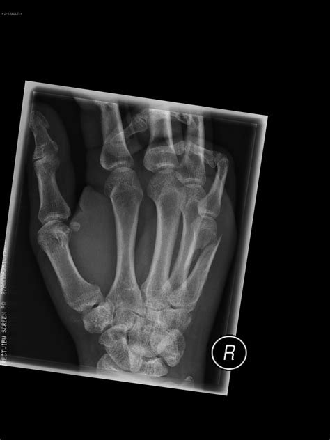 Fracture Of The Fifth Metacarpal Bone Image