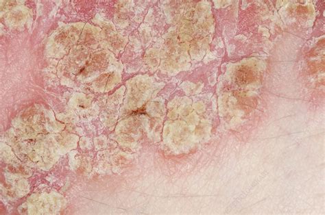 Plaque Psoriasis On The Skin Stock Image C0156018 Science Photo